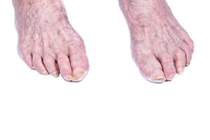 Natural Changes in Aging Feet