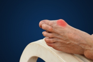 Symptoms and Prevention of Bunions and Bunionettes