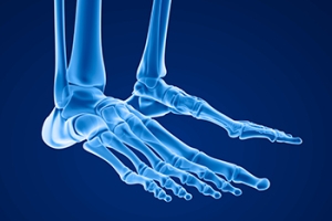 Stress Fractures in the Feet
