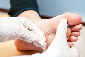 How Are Foot Warts Treated?