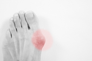 Easy to Spot a Bunion