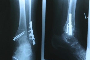 Stable vs Unstable Ankle Fractures