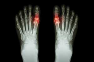 Foods That Can Trigger Gout
