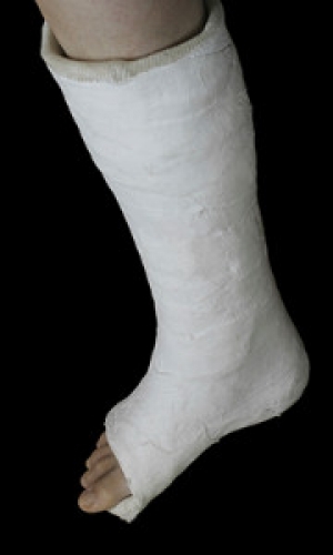 How A Broken Ankle is Treated