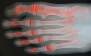 Treating Arthritis