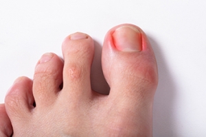 All About Ingrown Toenails