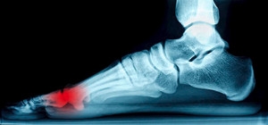 Sesamoid Bone Injuries