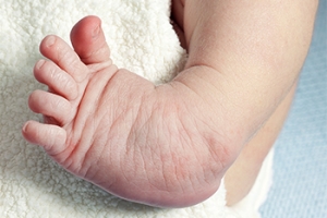 Common Congenital Foot Conditions
