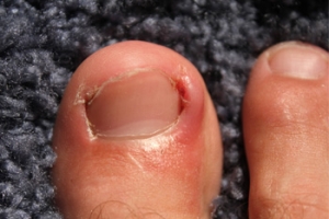 Reasons That Ingrown Toenails May Occur