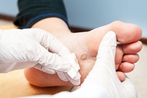 Where Do Plantar Warts Grow?