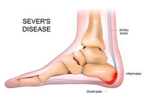 Gentle Stretches for Sever&#039;s Disease