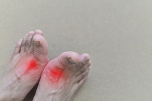 Gout in the Foot