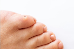 Common Causes of Foot Corns