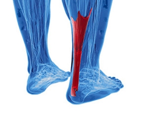What Is Achilles Tendinopathy?